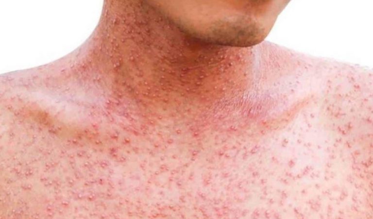 Ministerio de Salud activa el Comité Técnico Nacional de Control de Brote por Sarampión